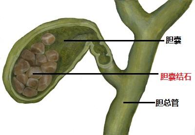 胆结石的原因有哪些?