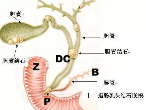 胆结石能自发消失吗?