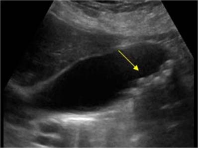 什么是多发性胆结石?