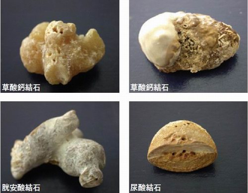 肾结石不同成分的解说