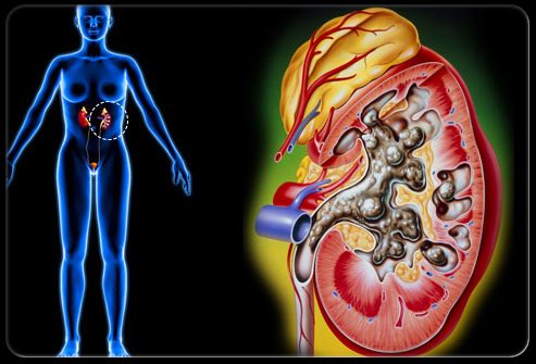 为什么得了肾结石没有疼痛?