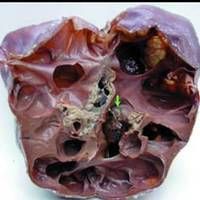 各种肾结石的特点