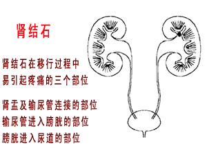 中医五绝网为您讲述肾结石的危害