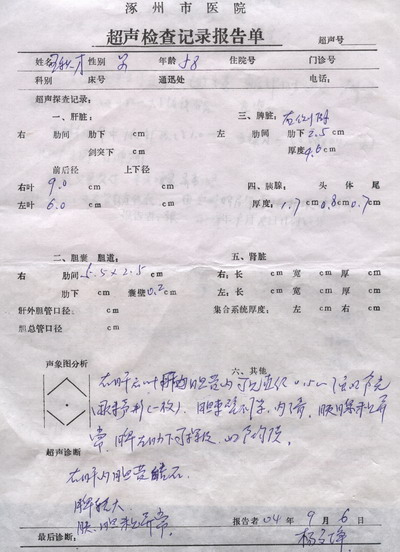 右肝内胆管结石合并左输石
