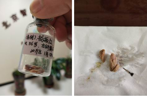 五绝指针疗法治疗肉状输尿管结石