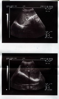 右肝内胆管结石合并左输石