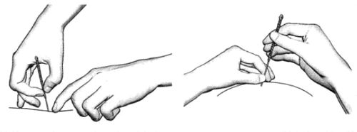 <a href=//www.yodicraft.com target=_blank class=infotextkey>中医</a>针刺之毫针疗法