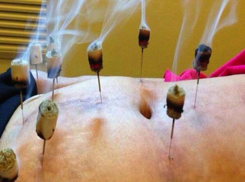 温针灸的应用及操作方法